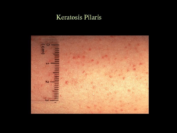 Keratosis Pilaris 