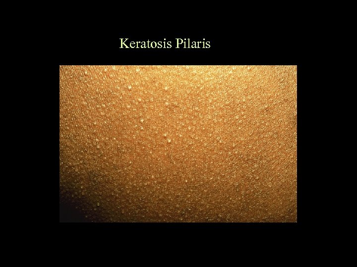 Keratosis Pilaris 