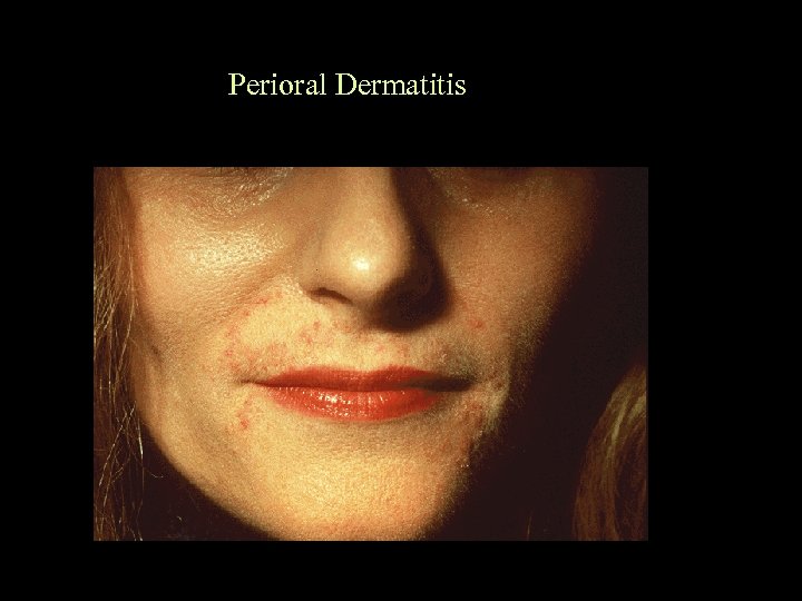 Perioral Dermatitis 