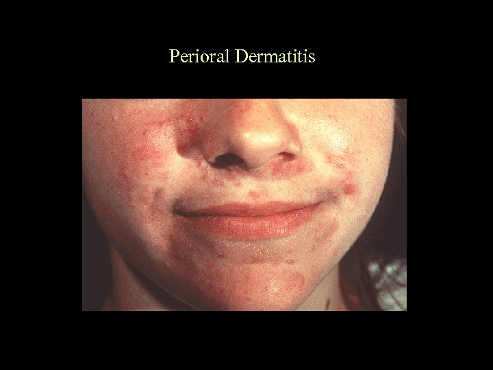 Perioral Dermatitis 