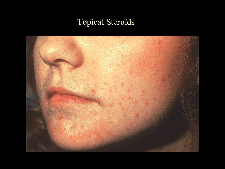 Topical Steroids 
