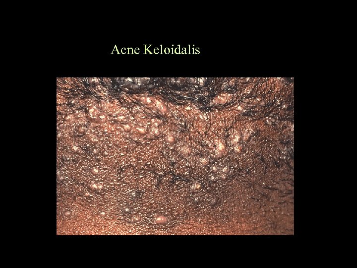 Acne Keloidalis 