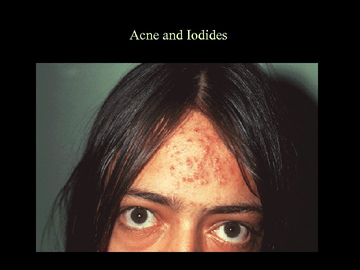 Acne and Iodides 