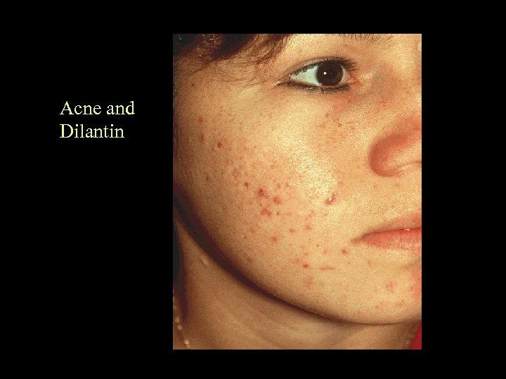 Acne and Dilantin 