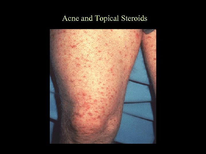 Acne and Topical Steroids 