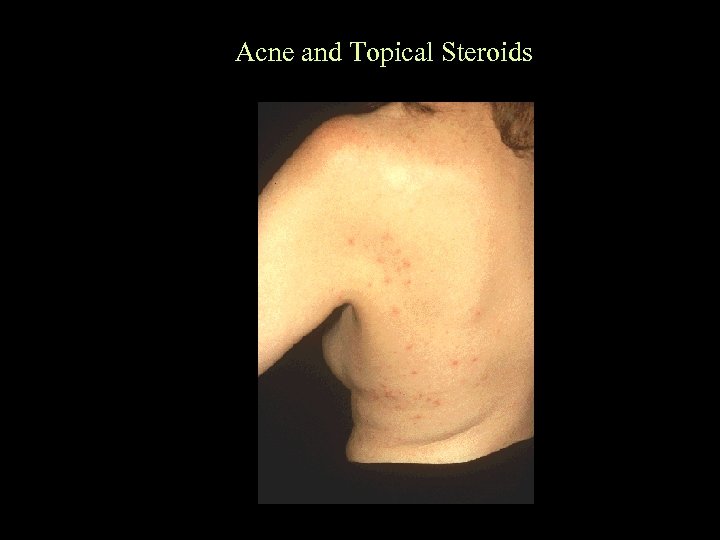 Acne and Topical Steroids 