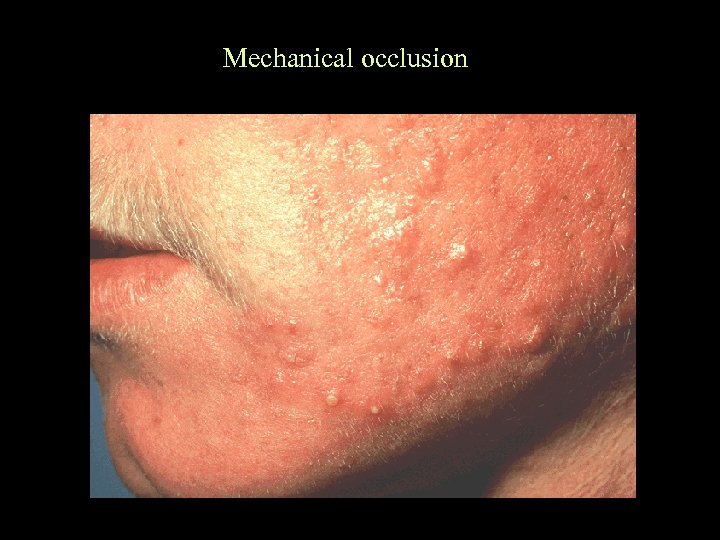 Mechanical occlusion 