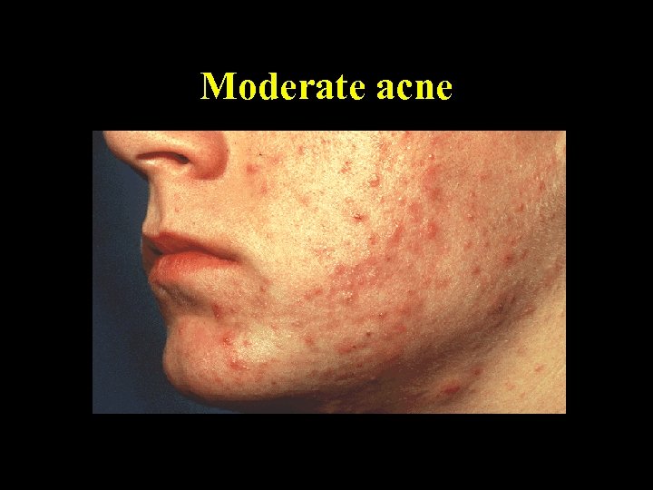 Moderate acne 