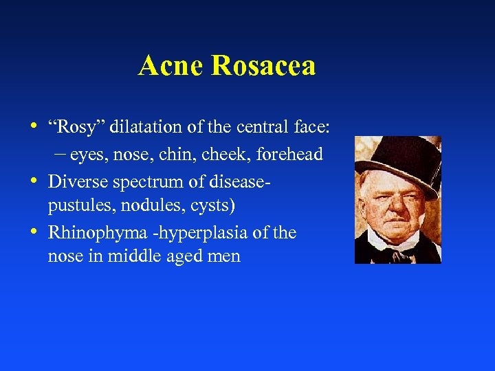 Acne Rosacea • “Rosy” dilatation of the central face: – eyes, nose, chin, cheek,