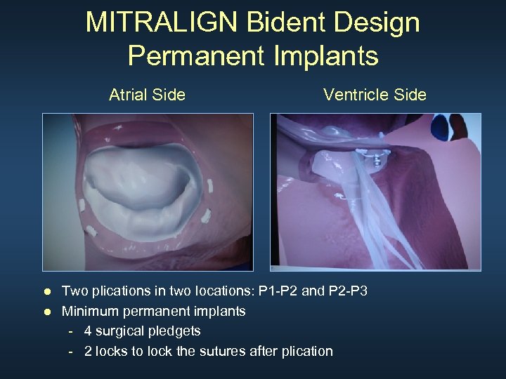 MITRALIGN Bident Design Permanent Implants Atrial Side Ventricle Side ● Two plications in two
