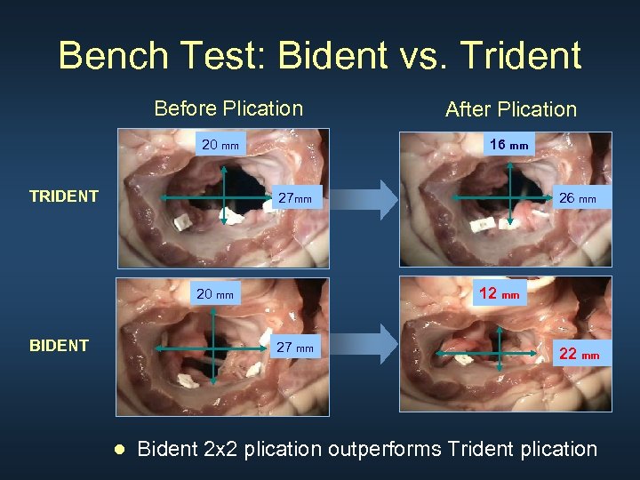 Bench Test: Bident vs. Trident Before Plication 20 mm TRIDENT 16 mm 27 mm