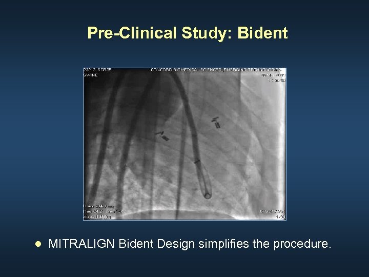 Pre-Clinical Study: Bident ● MITRALIGN Bident Design simplifies the procedure. 