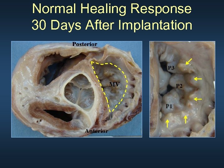 Normal Healing Response 30 Days After Implantation 