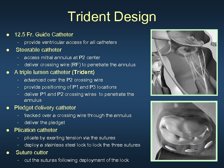 Trident Design ● 12. 5 Fr. Guide Catheter - ● provide ventricular access for