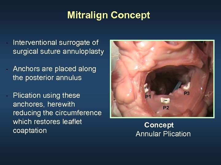 Mitralign Concept - Interventional surrogate of surgical suture annuloplasty - Anchors are placed along
