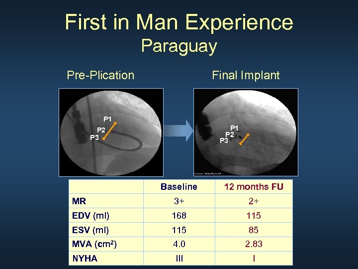 First in Man Experience Paraguay Pre-Plication Final Implant P 1 P 2 P 3