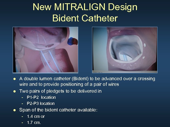 New MITRALIGN Design Bident Catheter ● A double lumen catheter (Bident) to be advanced