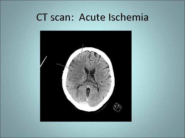 CT scan: Acute Ischemia 