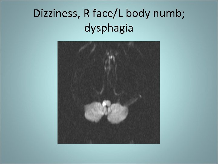 Dizziness, R face/L body numb; dysphagia 