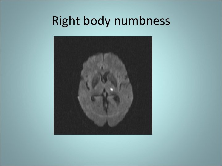Right body numbness 