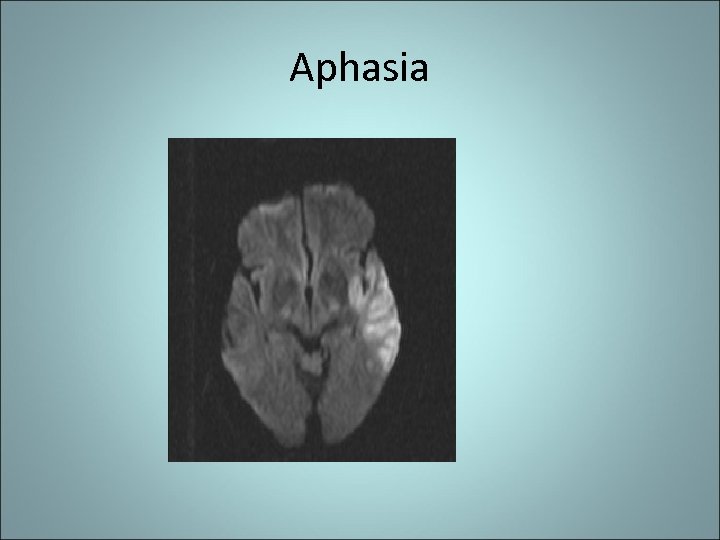 Aphasia 