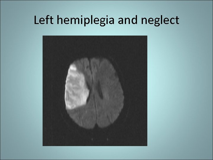 Left hemiplegia and neglect 