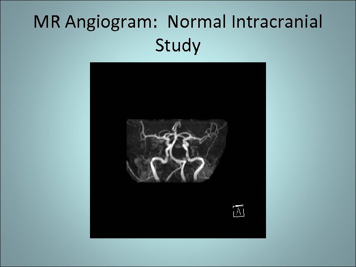 MR Angiogram: Normal Intracranial Study 