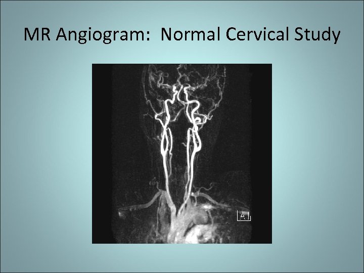 MR Angiogram: Normal Cervical Study 