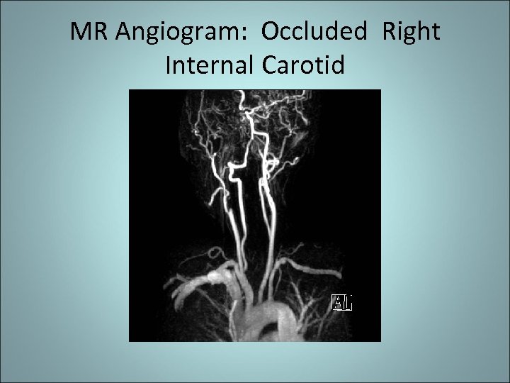 MR Angiogram: Occluded Right Internal Carotid 