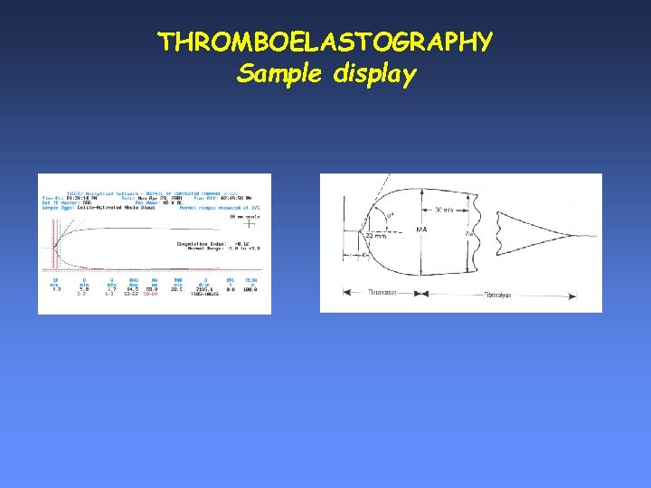 THROMBOELASTOGRAPHY Sample display 