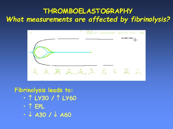 THROMBOELASTOGRAPHY What measurements are affected by fibrinolysis? Fibrinolysis leads to: • LY 30 /