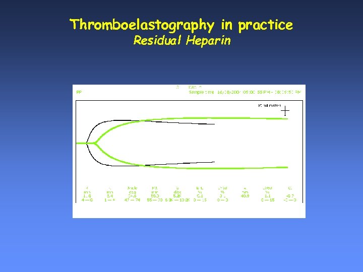 Thromboelastography in practice Residual Heparin 