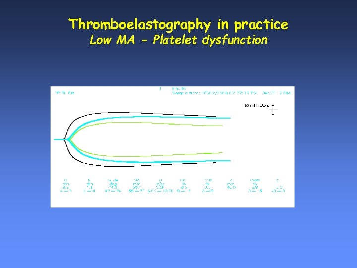 Thromboelastography in practice Low MA - Platelet dysfunction 