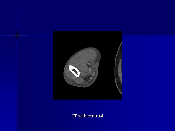CT with contrast 