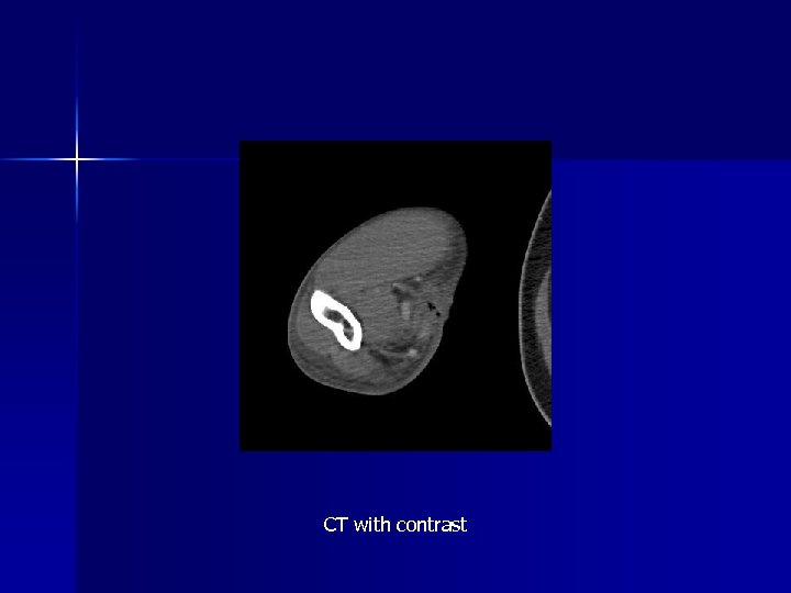 CT with contrast 