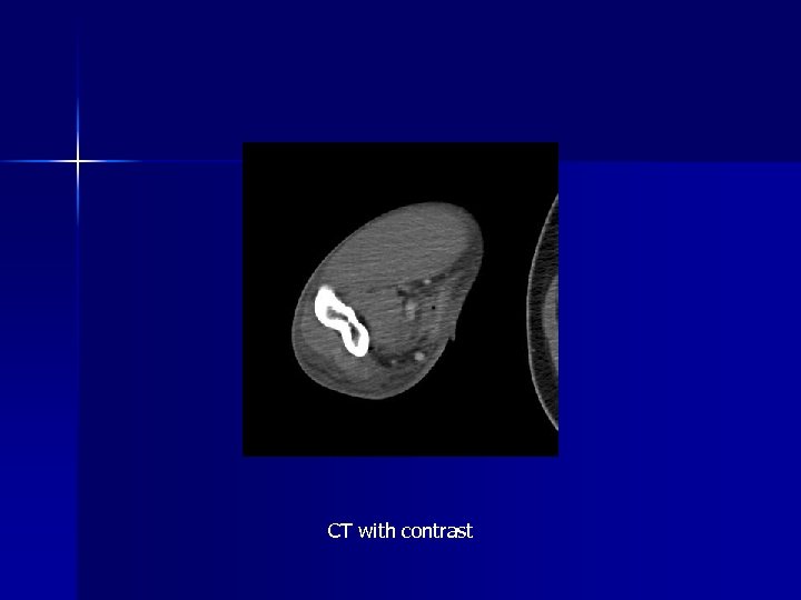 CT with contrast 