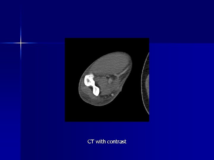 CT with contrast 