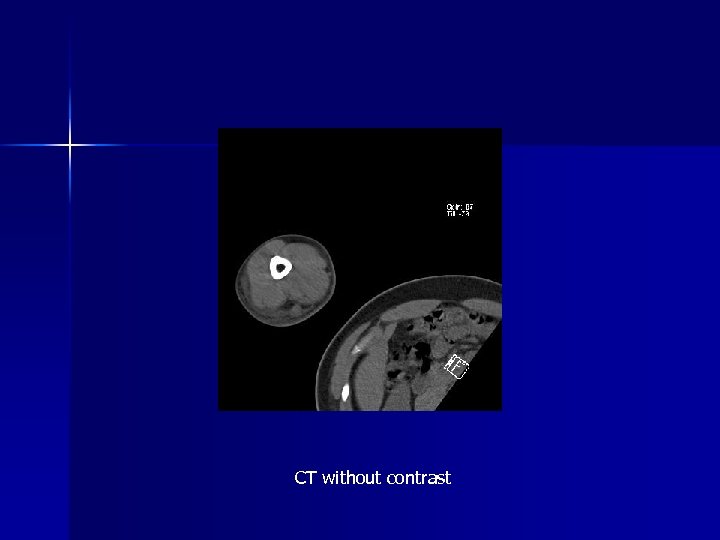 CT without contrast 