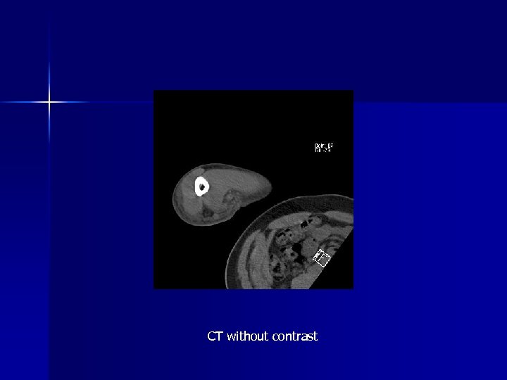 CT without contrast 