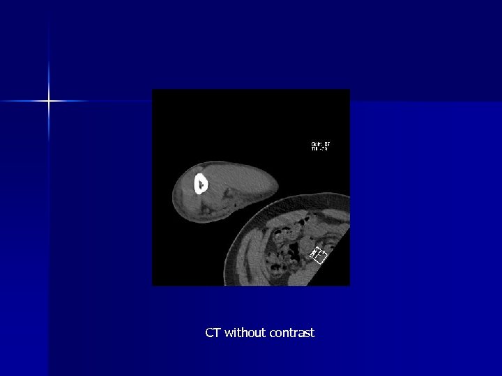 CT without contrast 