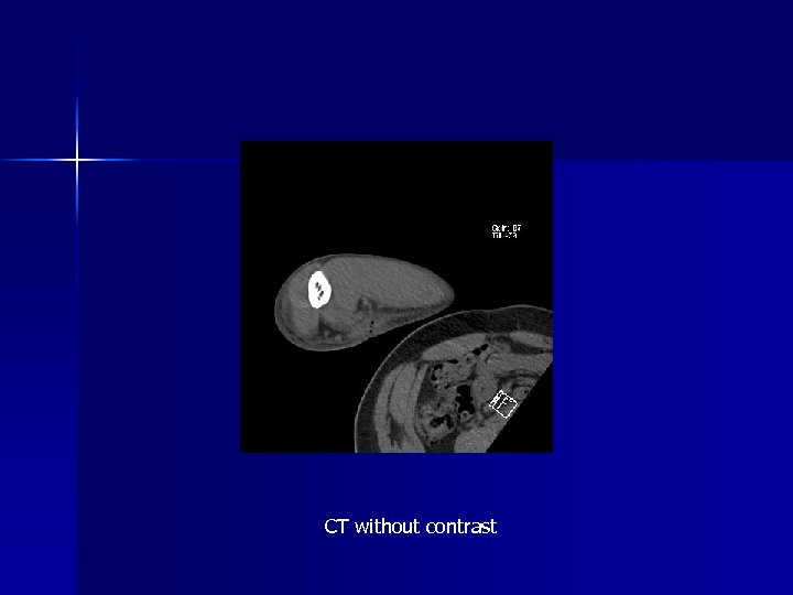 CT without contrast 