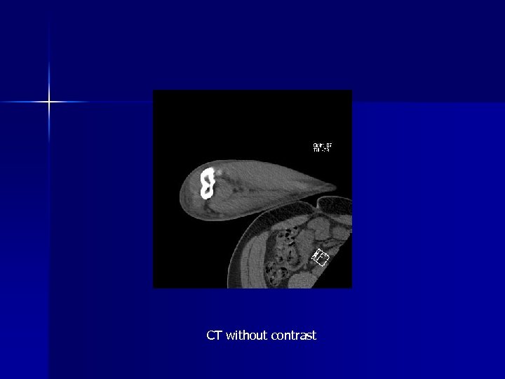 CT without contrast 