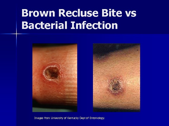 Brown Recluse Bite vs Bacterial Infection Images from University of Kentucky Dept of Entomology.