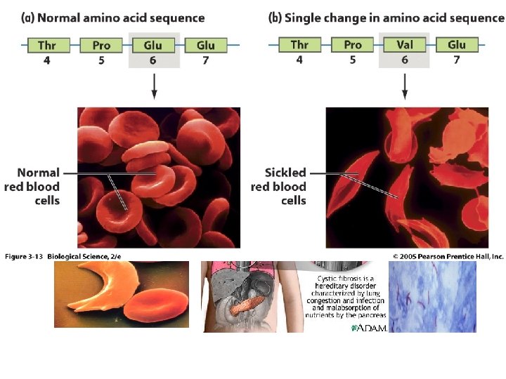 Многие распространенные наследственные болезни поддерживаются в популяци благодаря преимуществу гетерозигот. Возможно, ген муковисцидоза распространился