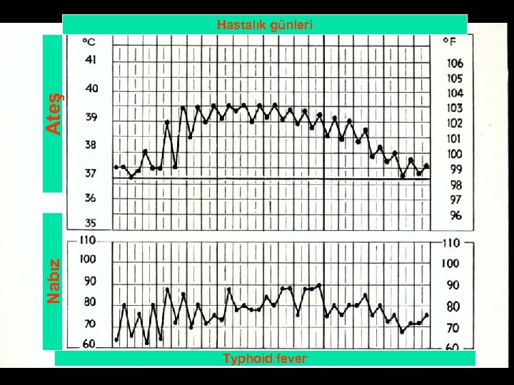 Nabız Ateş Hastalık günleri Typhoid fever 