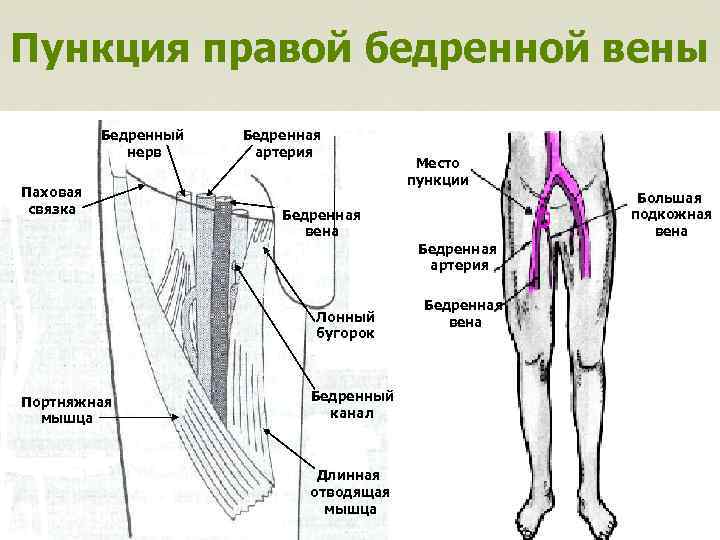 Пункция правой бедренной вены Бедренный нерв Паховая связка Бедренная артерия Место пункции Большая подкожная