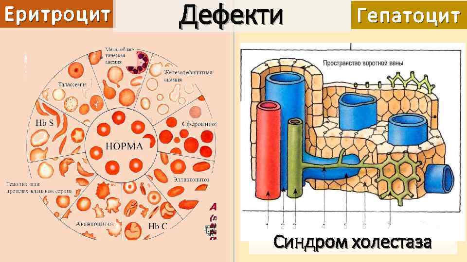 Еритроцит Дефекти Гепатоцит Синдром холестаза 