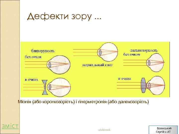 Дефекти зору. . . Міопія (або короткозорість) і гіперметропія (або далекозорість) зміст 2/18/2018 Білянський