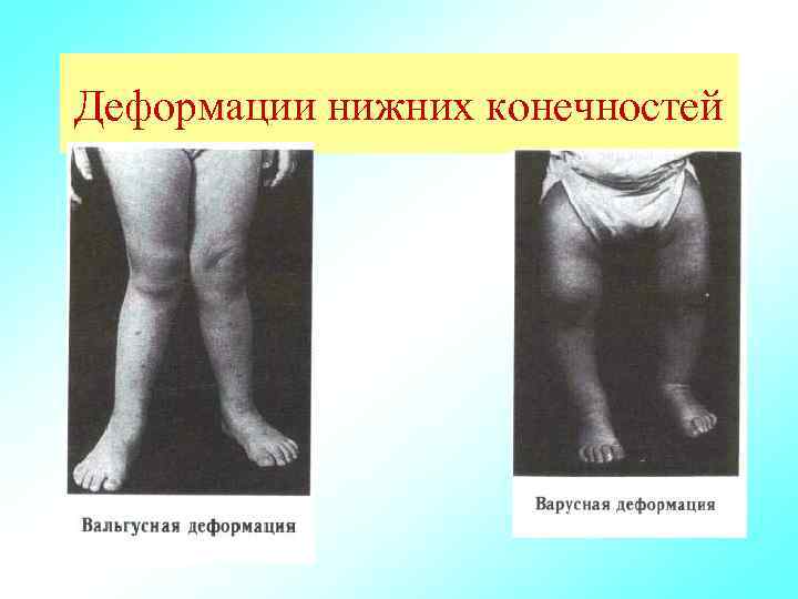Деформации нижних конечностей 