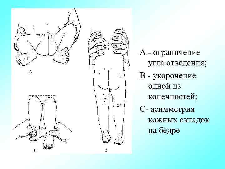 А ограничение угла отведения; В укорочение одной из конечностей; С асимметрия кожных складок на